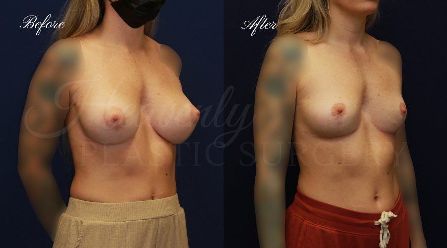 Breast Implant Removal + Breast Lift, Explant and Breast Lift, Breast Explant, Mastopexy, IMplant removal and mastopexy, plastic surgery before and after, plastic surgery revision, implant removal before and after, breast implant removal before and after, breast implant removal surgeon, breast implant removal orange county Breast Implant Removal + Breast Lift, Explant and Breast Lift, Breast Explant, Mastopexy, IMplant removal and mastopexy, plastic surgery before and after, plastic surgery revision, implant removal before and after, breast implant removal before and after, breast implant removal surgeon, breast implant removal orange county