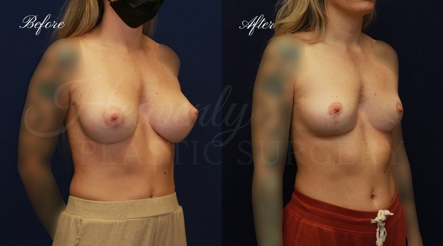 Breast Implant Removal + Breast Lift, Explant and Breast Lift, Breast Explant, Mastopexy, IMplant removal and mastopexy, plastic surgery before and after, plastic surgery revision, implant removal before and after, breast implant removal before and after, breast implant removal surgeon, breast implant removal orange county