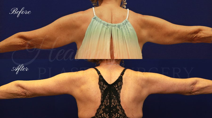 Arm Lift JECO back Plastic Surgery, Liposuction, Arm Lift, Brachioplasty, arms, bat wings