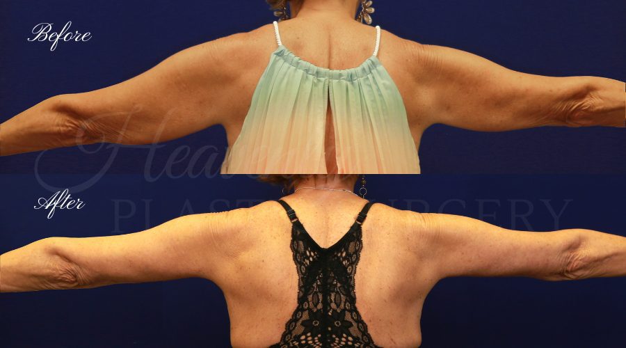 Plastic Surgery, Liposuction, Arm Lift, Brachioplasty, arms, bat wings