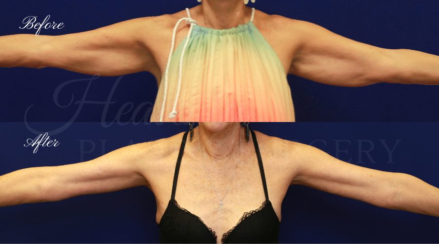 Plastic Surgery, Liposuction, Arm Lift, Brachioplasty, arms, bat wings