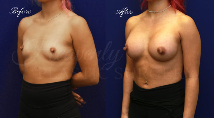 Breast Aug left obl VCD breast augmentation, breast augmentation surgery, breast augmentation surgeon, breast augmentation orange county, breast augmentation with silicone implants, sientra implants, boob job, boob job surgeon, breast implant surgeon, plastic surgery orange county, lake forest plastic surgeon, breast augmentation lake forest, south oc plastic surgeon
