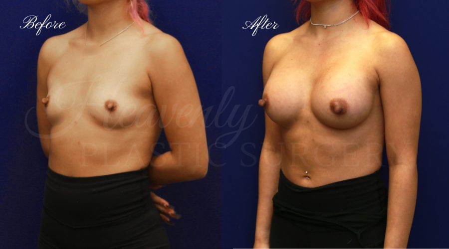 breast augmentation, breast augmentation surgery, breast augmentation surgeon, breast augmentation orange county, breast augmentation with silicone implants, sientra implants, boob job, boob job surgeon, breast implant surgeon, plastic surgery orange county, lake forest plastic surgeon, breast augmentation lake forest, south oc plastic surgeon