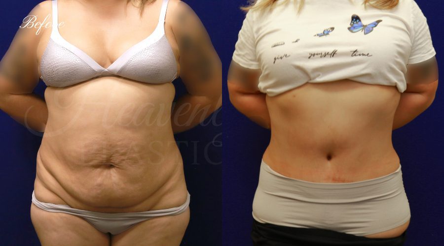 Enlarged & rounded mons pubis 2 years after tummy tuck? (Photo)