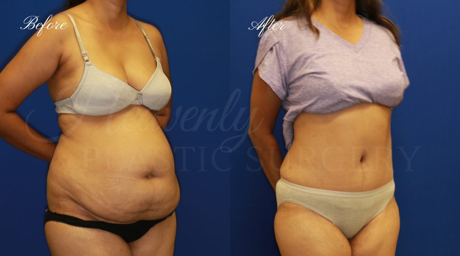 Tummy-Tuck-with-Liposuction-Before-After-Right-Oblique-HADE Plastic Surgery, plastic surgeon, tummy tuck, abdominoplasty