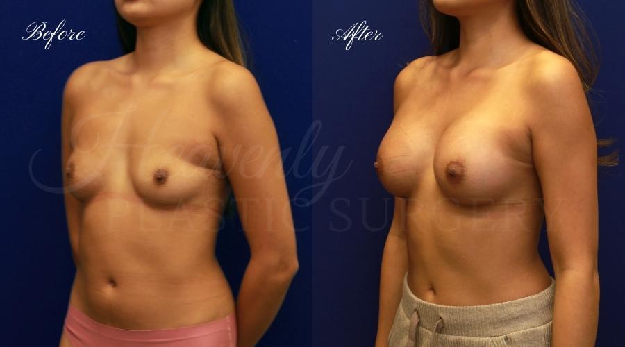 breast augmentation, breast augmentation surgery, breast augmentation surgeon, breast augmentation orange county, breast augmentation with silicone implants, sientra implants, boob job, boob job surgeon, breast implant surgeon, plastic surgery orange county, lake forest plastic surgeon, breast augmentation lake forest, south oc plastic surgeon