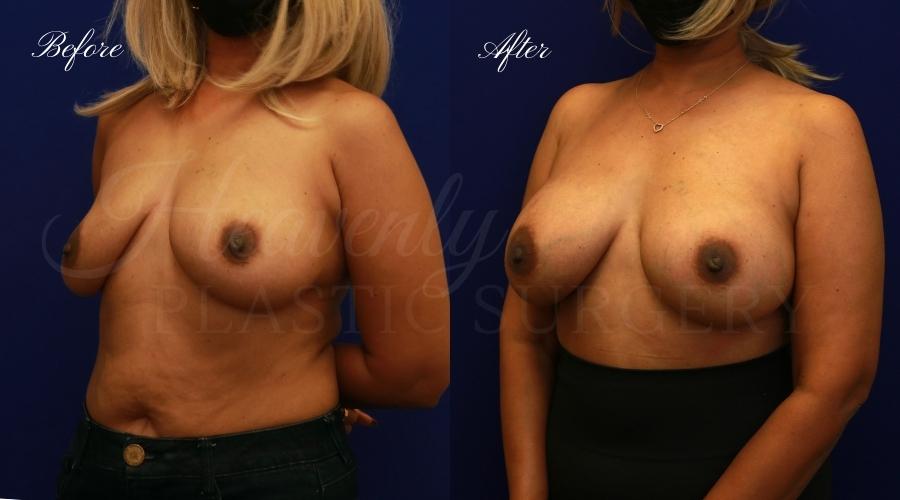 breast augmentation, breast augmentation surgery, breast augmentation surgeon, breast augmentation orange county, breast augmentation with silicone implants, sientra implants, boob job, boob job surgeon, breast implant surgeon, plastic surgery orange county, lake forest plastic surgeon, breast augmentation lake forest, south oc plastic surgeon