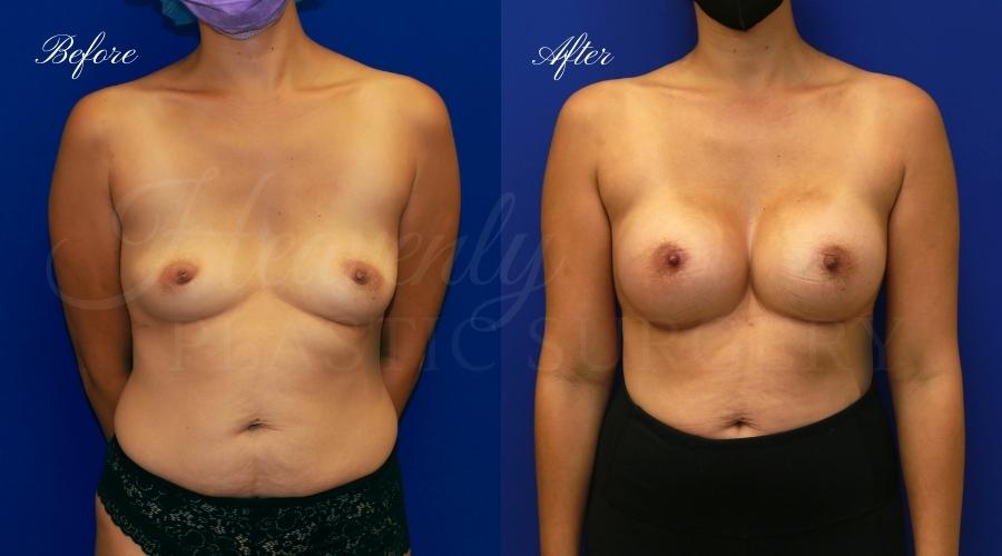 breast aug DeEm breast augmentation, breast augmentation surgery, breast augmentation surgeon, breast augmentation orange county, breast augmentation with silicone implants, sientra implants, boob job, boob job surgeon, breast implant surgeon, plastic surgery orange county, lake forest plastic surgeon, breast augmentation lake forest, south oc plastic surgeon