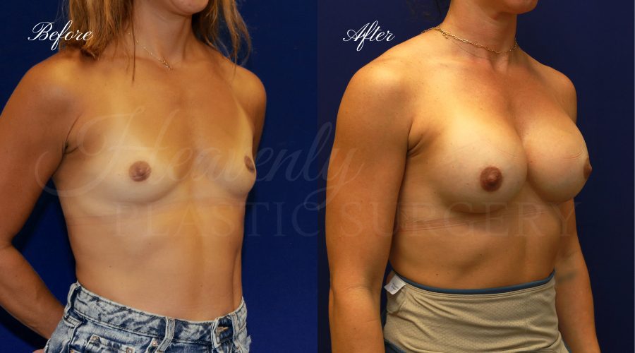 breast augmentation, breast augmentation surgery, breast augmentation surgeon, breast augmentation orange county, breast augmentation with silicone implants, sientra implants, boob job, boob job surgeon, breast implant surgeon, plastic surgery orange county, lake forest plastic surgeon, breast augmentation lake forest, south oc plastic surgeon