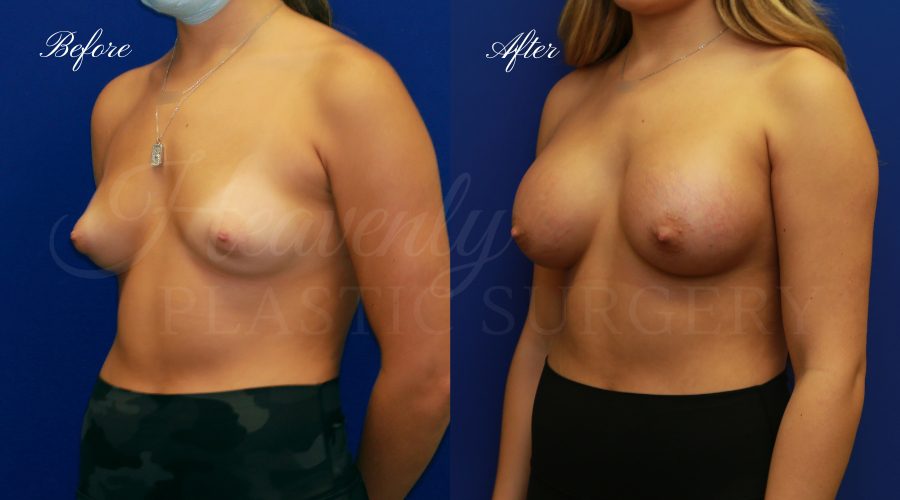 breast augmentation, breast augmentation surgery, breast augmentation surgeon, breast augmentation orange county, breast augmentation with silicone implants, sientra implants, boob job, boob job surgeon, breast implant surgeon, plastic surgery orange county, lake forest plastic surgeon, breast augmentation lake forest, south oc plastic surgeon