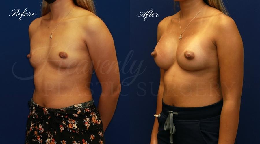 breast aug VASA breast augmentation, breast augmentation surgery, breast augmentation surgeon, breast augmentation orange county, breast augmentation with silicone implants, sientra implants, boob job, boob job surgeon, breast implant surgeon, plastic surgery orange county, lake forest plastic surgeon, breast augmentation lake forest, south oc plastic surgeon