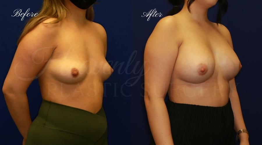 breast aug VaFi breast augmentation, breast augmentation surgery, breast augmentation surgeon, breast augmentation orange county, breast augmentation with silicone implants, sientra implants, boob job, boob job surgeon, breast implant surgeon, plastic surgery orange county, lake forest plastic surgeon, breast augmentation lake forest, south oc plastic surgeon
