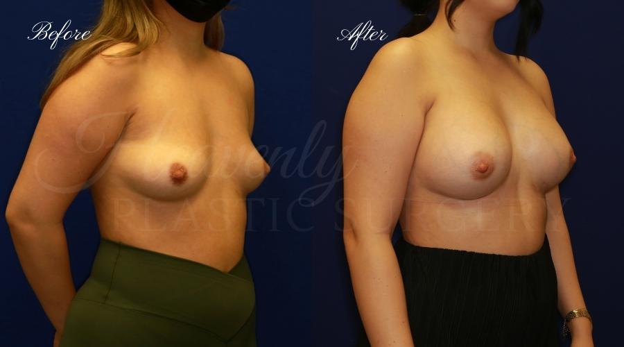 breast augmentation, breast augmentation surgery, breast augmentation surgeon, breast augmentation orange county, breast augmentation with silicone implants, sientra implants, boob job, boob job surgeon, breast implant surgeon, plastic surgery orange county, lake forest plastic surgeon, breast augmentation lake forest, south oc plastic surgeon