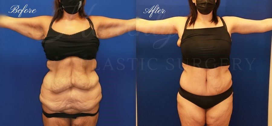 Mommy-Makeover-Arm-Lift-Tummy-Tuck-Before-and-After-Front-RATH Mommy-Makeover-Arm-Lift-Tummy-Tuck-Before-and-After-Front-RATH