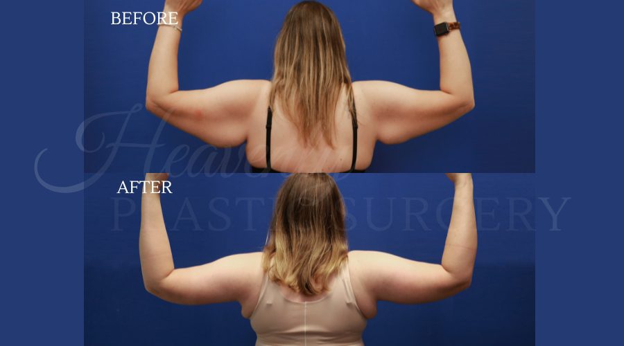 Arm Lift LEHE bent Arm Lift LEHE bent