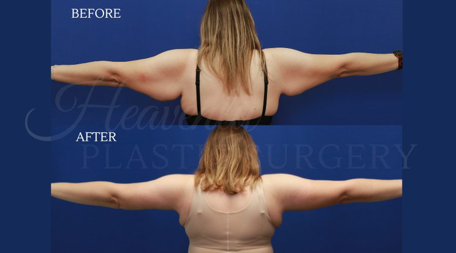 Arm Lift LEHE Arm-Lift-LEHE.jpg