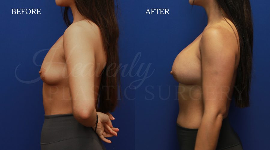 Breast Aug L side FOLA Breast Aug L side FOLA.jpg