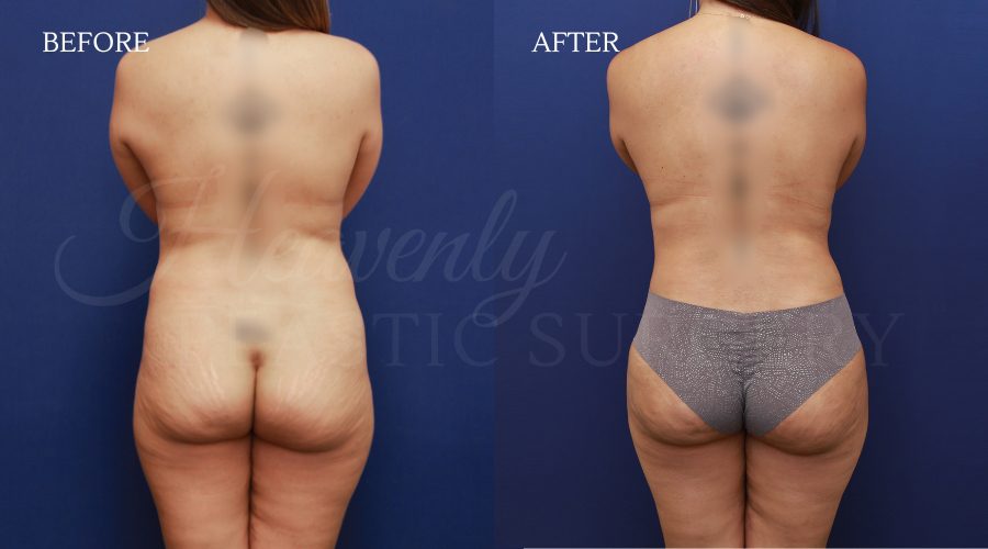Breast Aug+ Tummy Tuck + BFGH + Back Lipo ODGA Breast-Aug-Tummy-Tuck-BFGH-Back-Lipo-ODGA