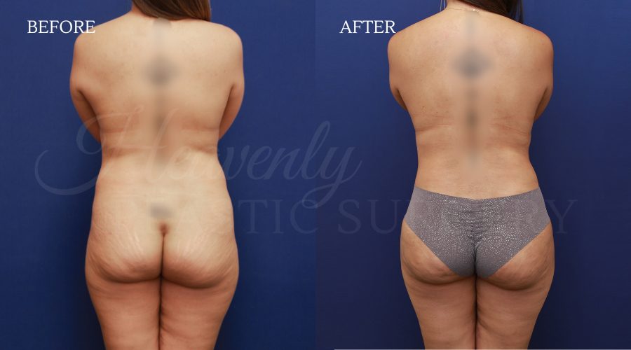 Breast-Aug-Tummy-Tuck-BFGH-Back-Lipo-ODGA