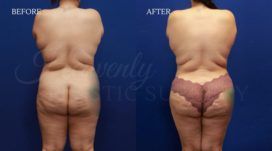 Breast Lift + Tummy Tuck + BFGH + Thigh Lipo IVME