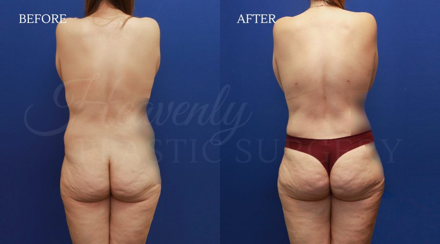 TT + back lipo BFGH + Br Lift MAFR back TT-back-lipo-BFGH-Br-Lift-MAFR-back.jpg