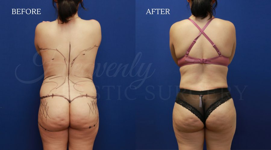 Tummy Tuck +BFGH + Back Lipo ERRO