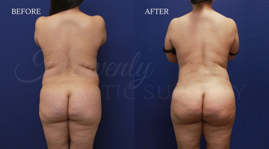Tummy Tuck +BFGH + Back Lipo JAES Tummy Tuck +BFGH + Back Lipo JAES