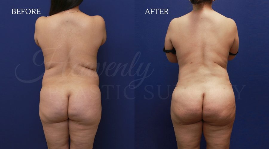 Tummy Tuck +BFGH + Back Lipo JAES