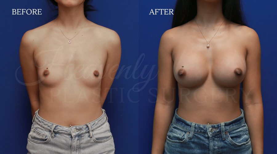 Breast-Augmentation-CHSO-front