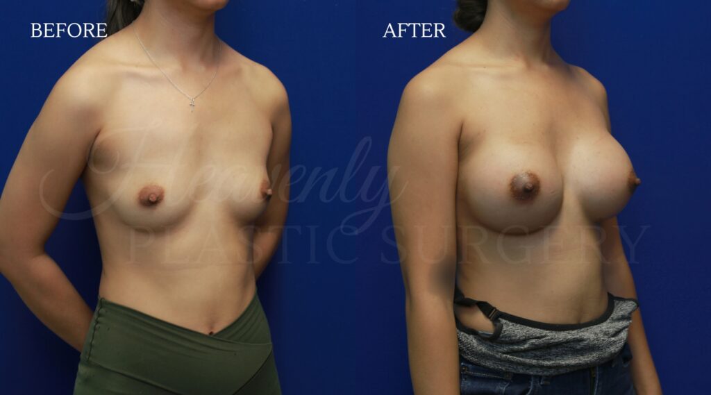 Breast-Augmentation-DEOS-obl