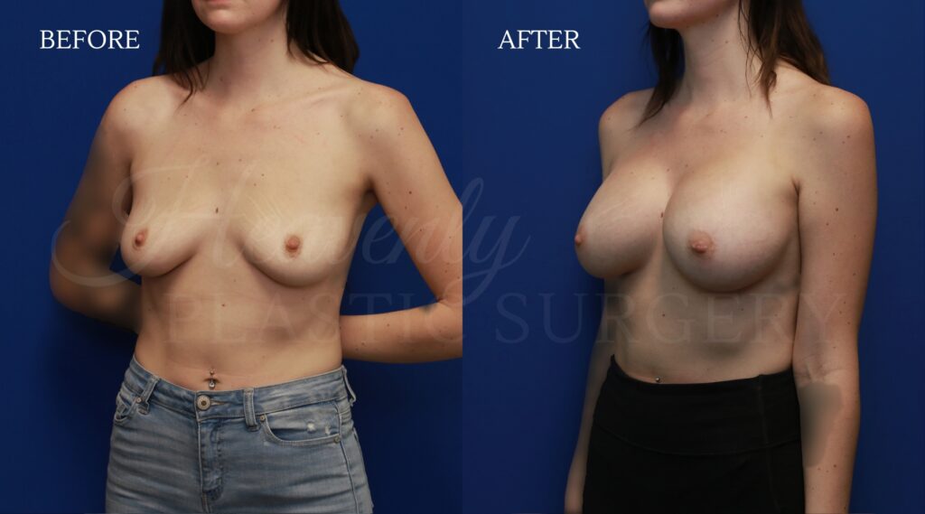 Breast-Augmentation-KAGR-obl