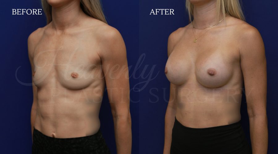 Breast-Augmentation-NILI-obl-.jpg