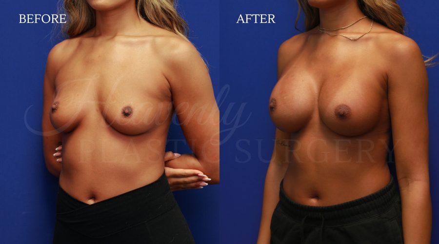 Breast-Augmentation-TOPE-obl