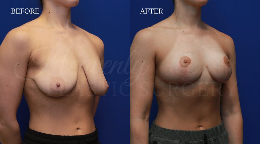 Breast Lift TAZU Breast-Lift-TAZU.jpg