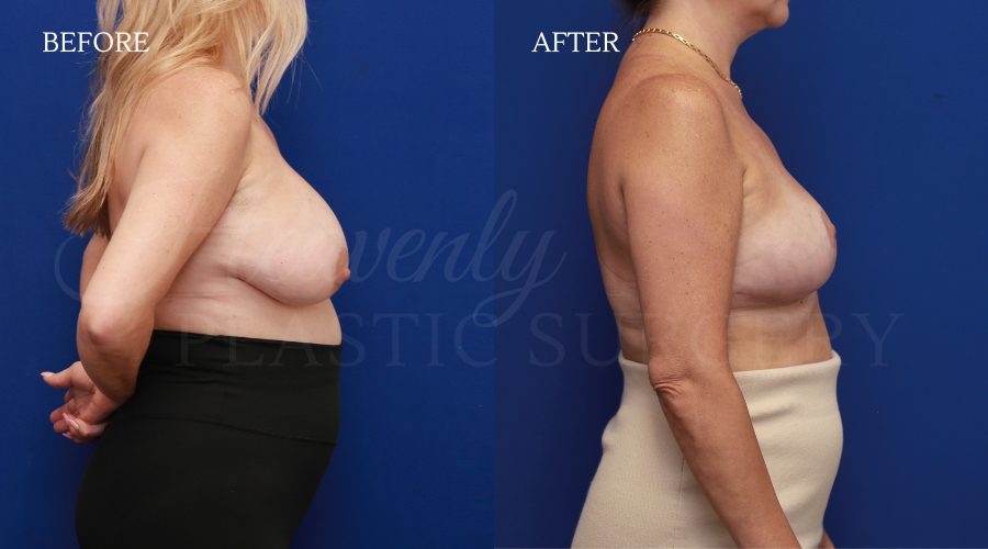 Explant+ Breast Lift DADE side Explant-Breast-Lift-DADE-side.jpg