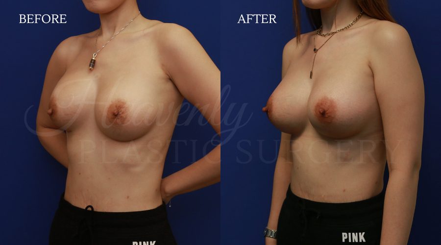 Implant Exchange+Capsulectomy AMKH Implant-ExchangeCapsulectomy-AMKH.jpg