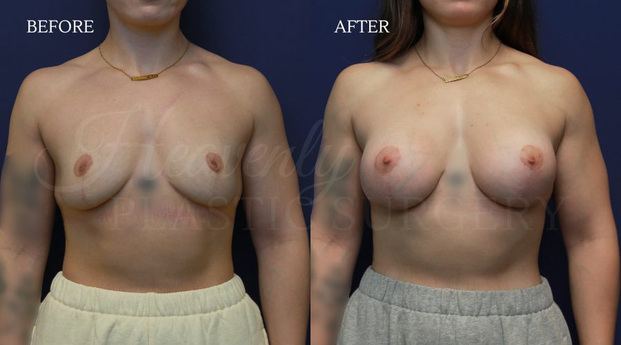 YVCA Over the Muscle Breast Aug after Breast Lift (1) YVCA-Over-the-Muscle-Breast-Aug-after-Breast-Lift-1.jpg
