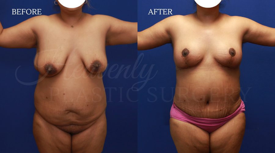 Arm-Lift-Breast-Lift-Lateral-Chest-Excision-Buffalo-Hump-Lipo-Tummy-Tuck-BFGH-PRME.jpg