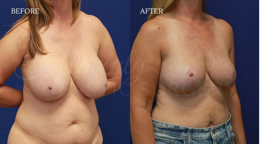 Explant+Breast Lift THMA ExplantBreast-Lift-THMA.jpg